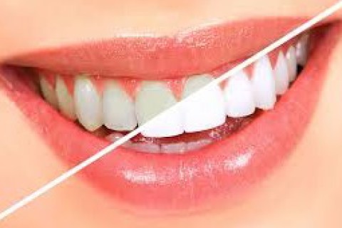 Branqueamento Dental: Mitos, verdades e cuidados necessários
